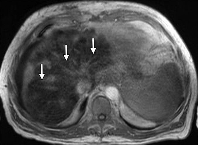 Medical MRI scan showing early signs of fatty liver infiltration